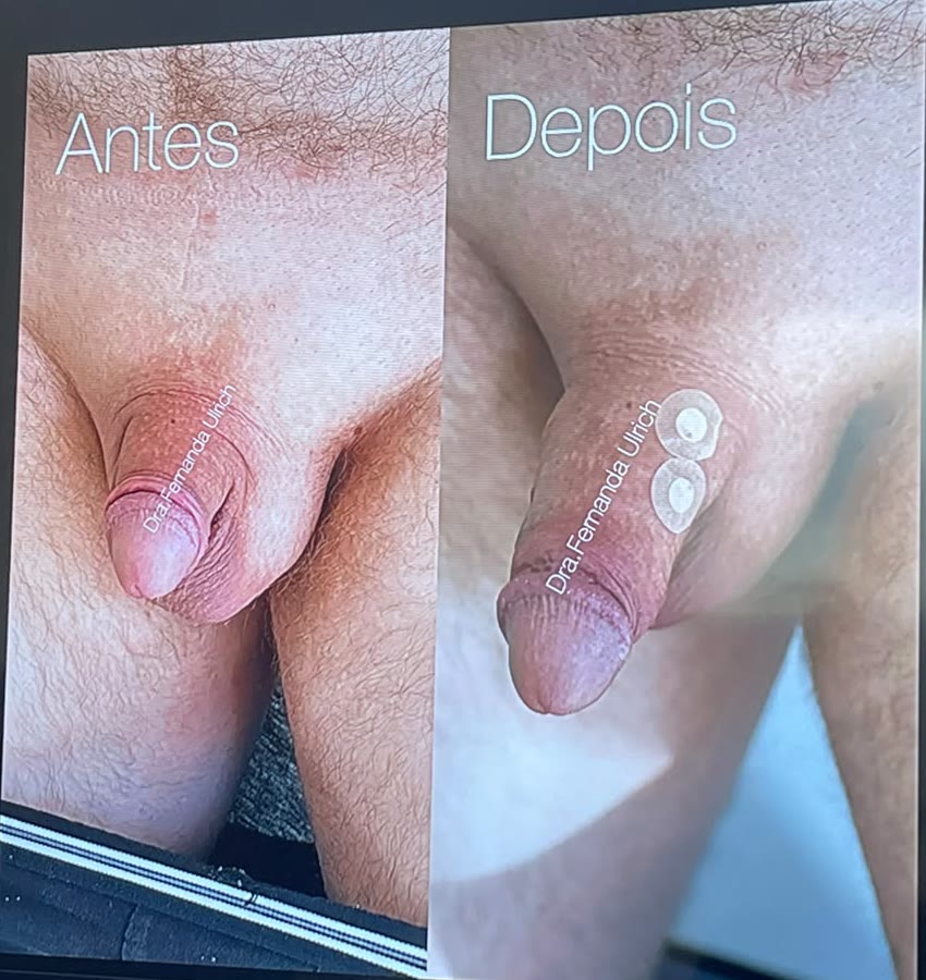 Antes e depois do Método Uro Power